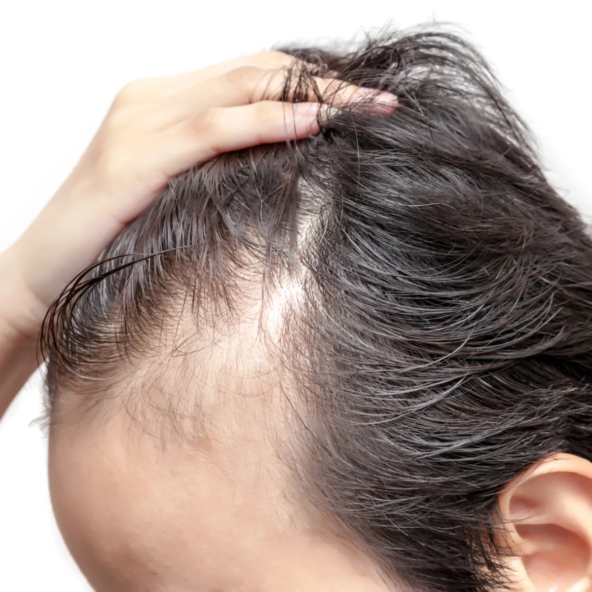 Alopecia Androgénica en Hombres