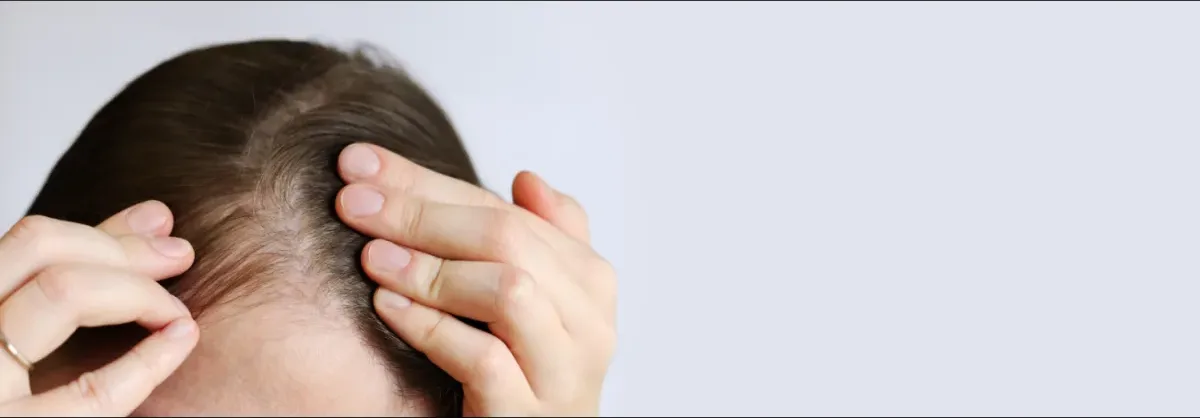 Alopecia Androgénica en Mujeres