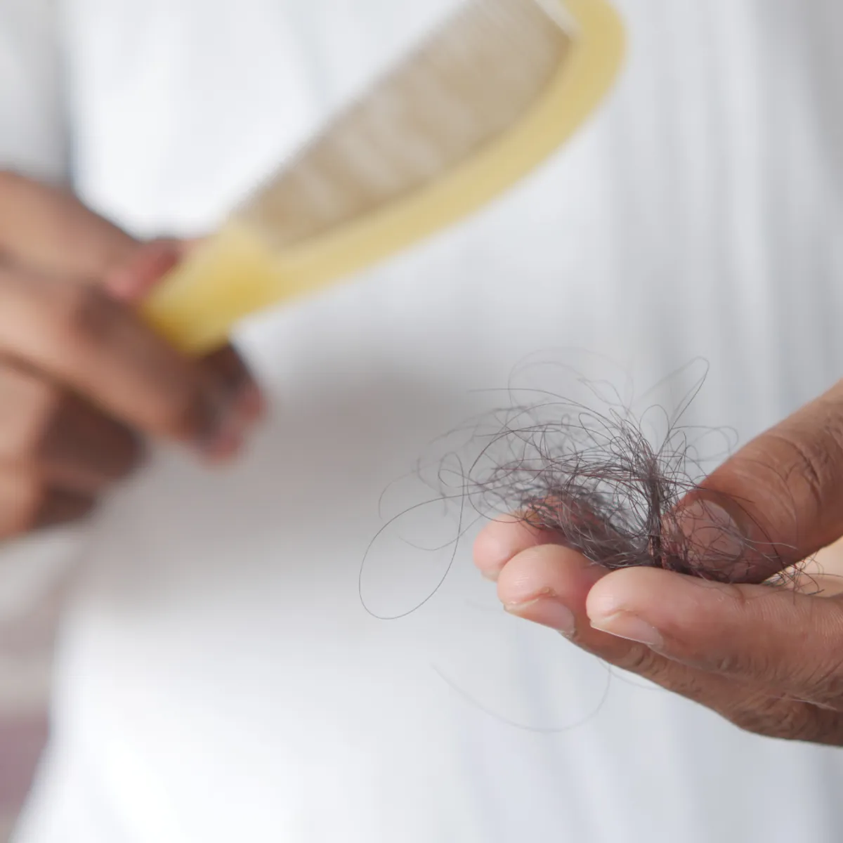 Alopecia Frontal Fibrosante