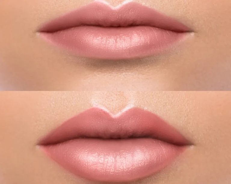 Aumento de labios — Arenas Clínica Médica