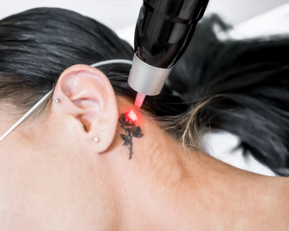 Eliminación de tatuajes