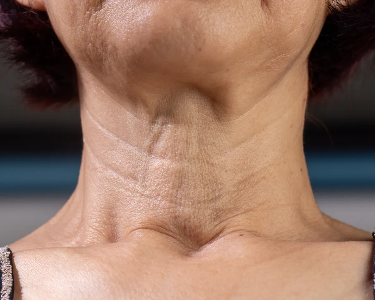 Flacidez facial