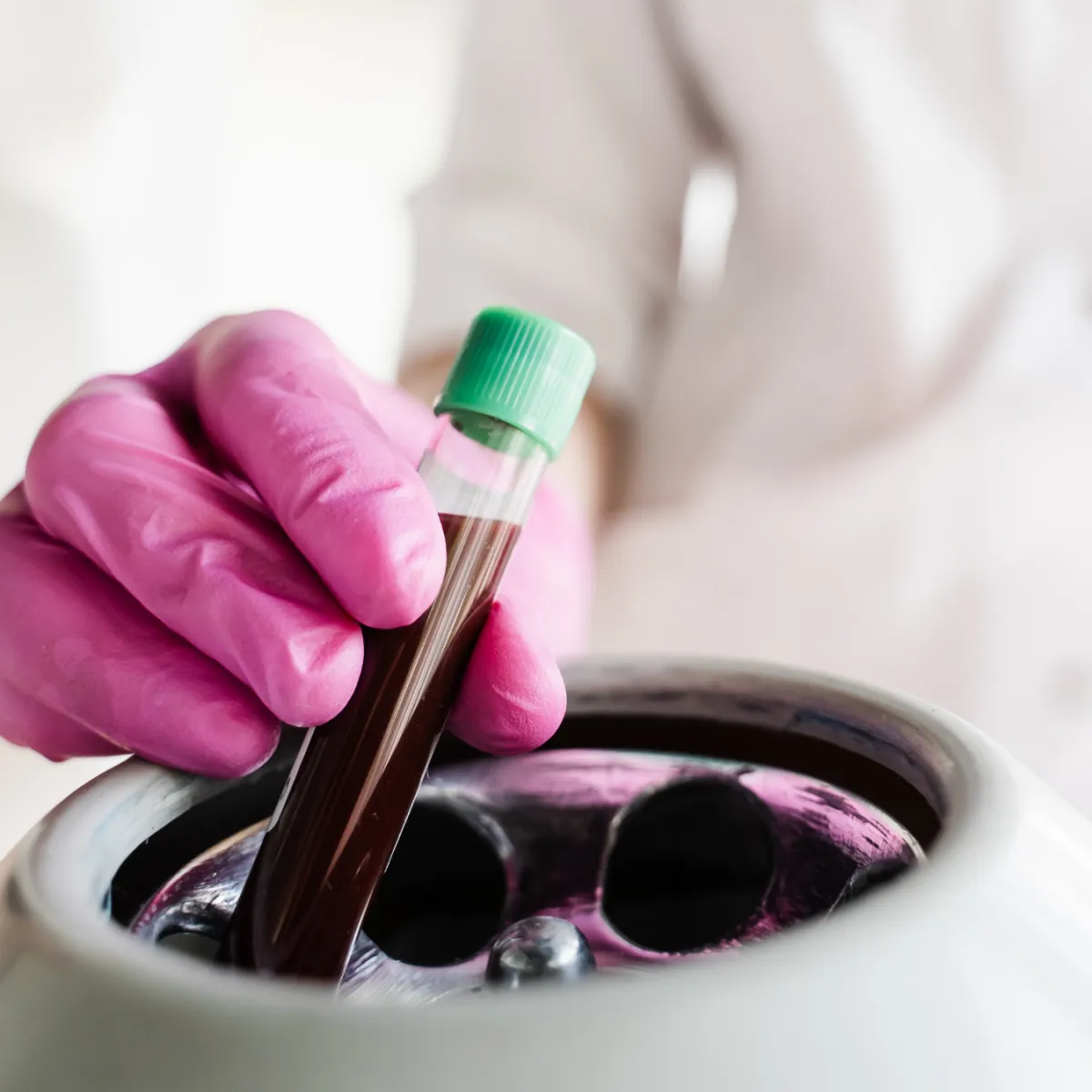 Plasma Rico en Plaquetas para Pelo (PRP)