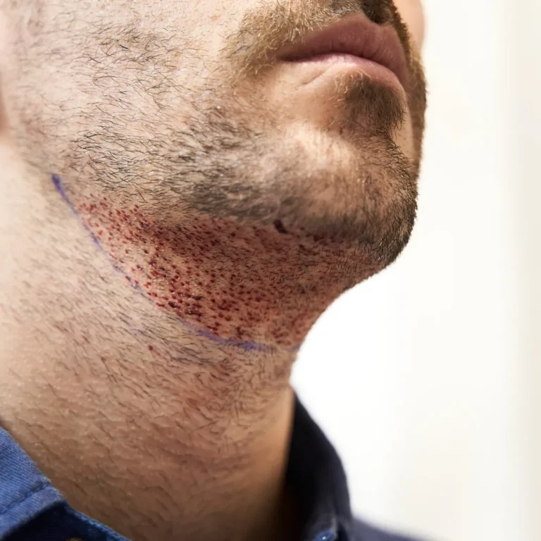 Trasplante de barba — Arenas Clínica Médica