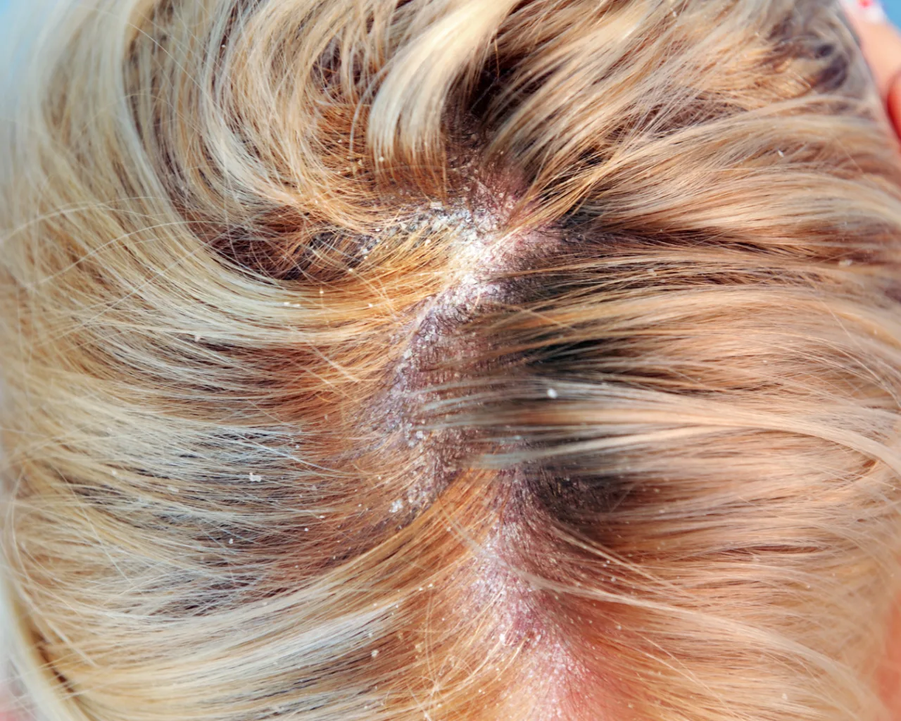 Dermatitis Seborreica