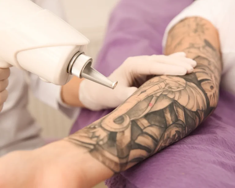Eliminacion tatuajes dermatologia