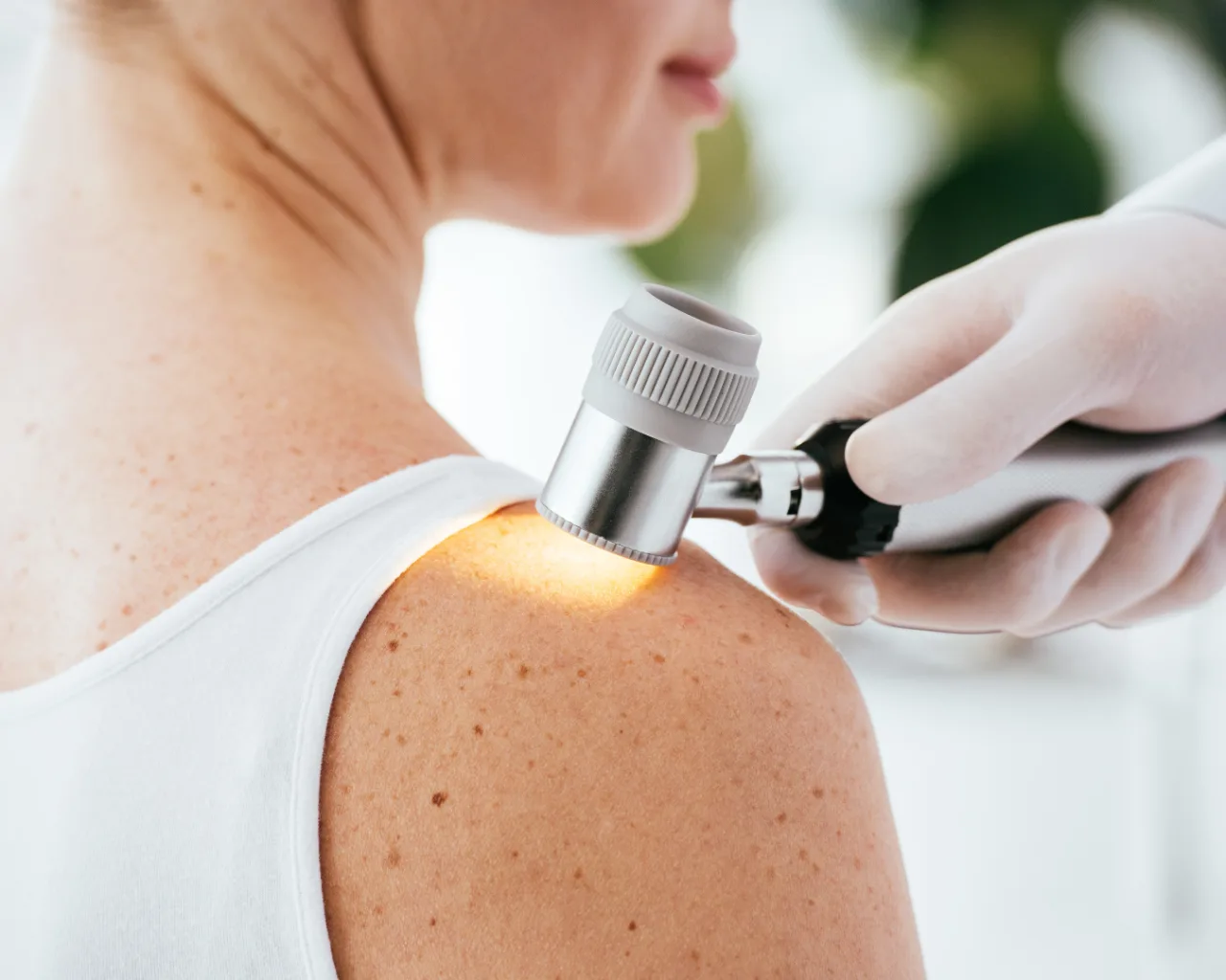 Diagnóstico de Melanoma