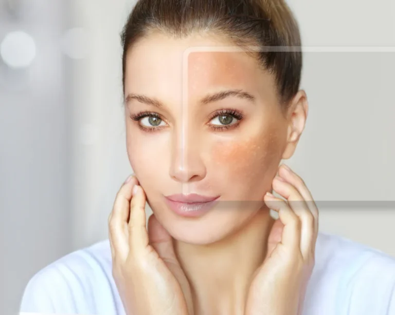 Melasma