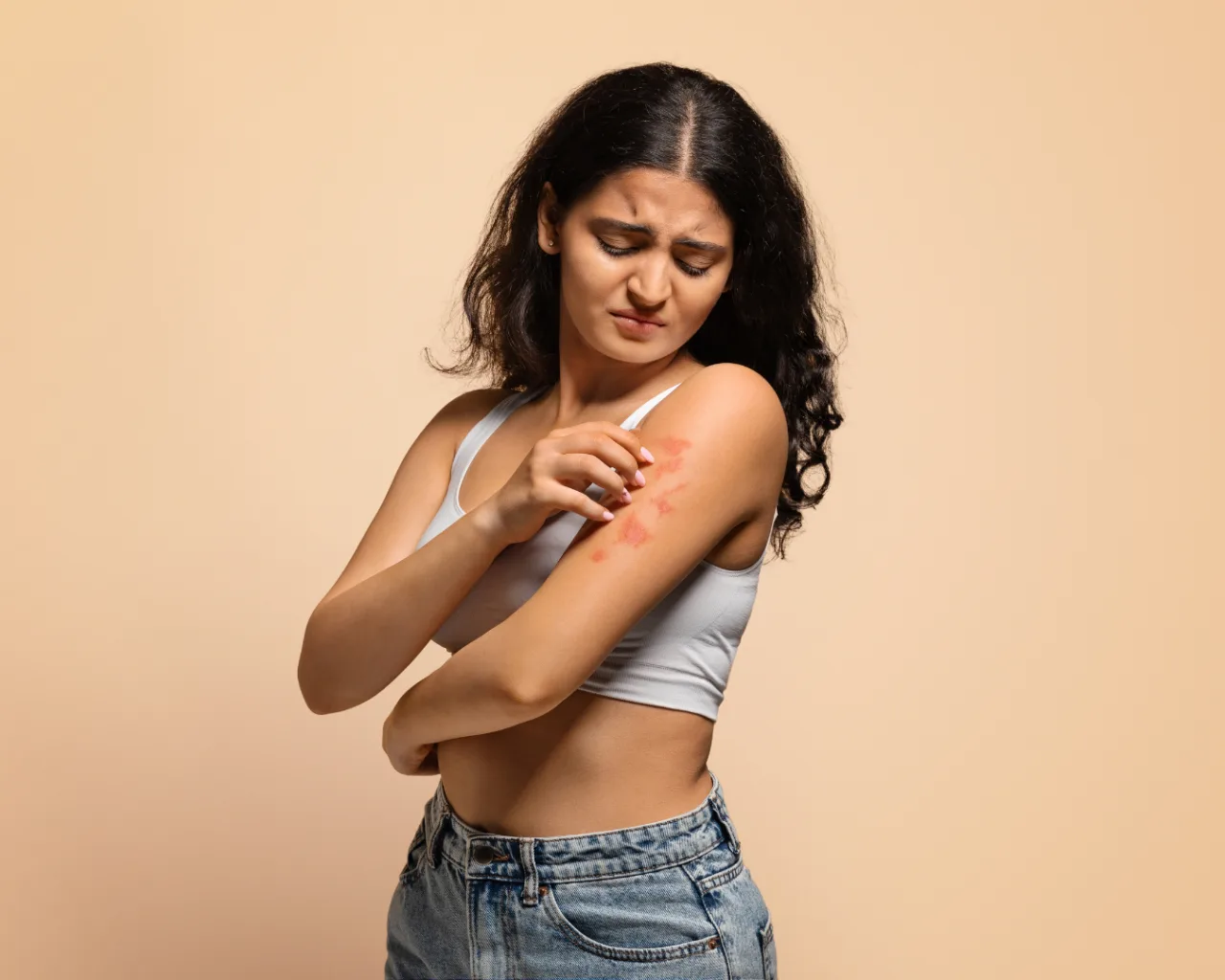 Psoriasis