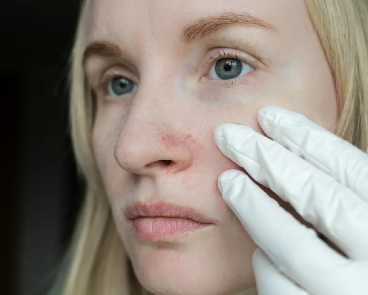 Rosacea