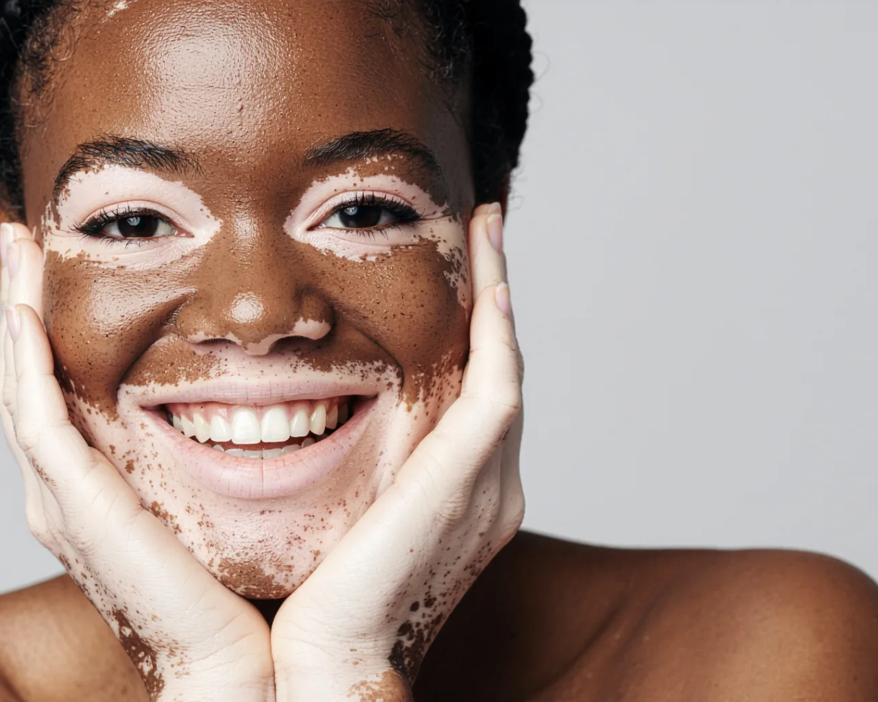 Vitiligo