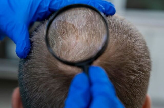Un hombre con pérdida de densidad capilar